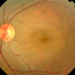Fotografia del fondo oculare in caso di corioretinopatia sierosa centrale.